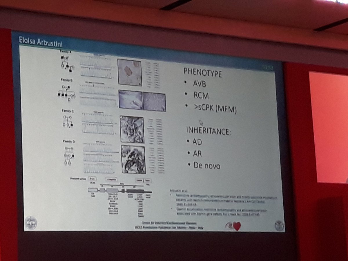 SilCastelletti's tweet photo. Prof Arbustini shows the key features of the #RCM restrictive #Cardiomyopathy due to mutations on Desmin: AV block & CPK elevation are some of them! #Genetics #SIC2018 #SICCongress #ItalianSocietyOfCardiology @Cipeciop1964 @CrottiLia @glimongelli @pelliccia_f @jpvantintelen https://t.co/8uSrA2ZpU1