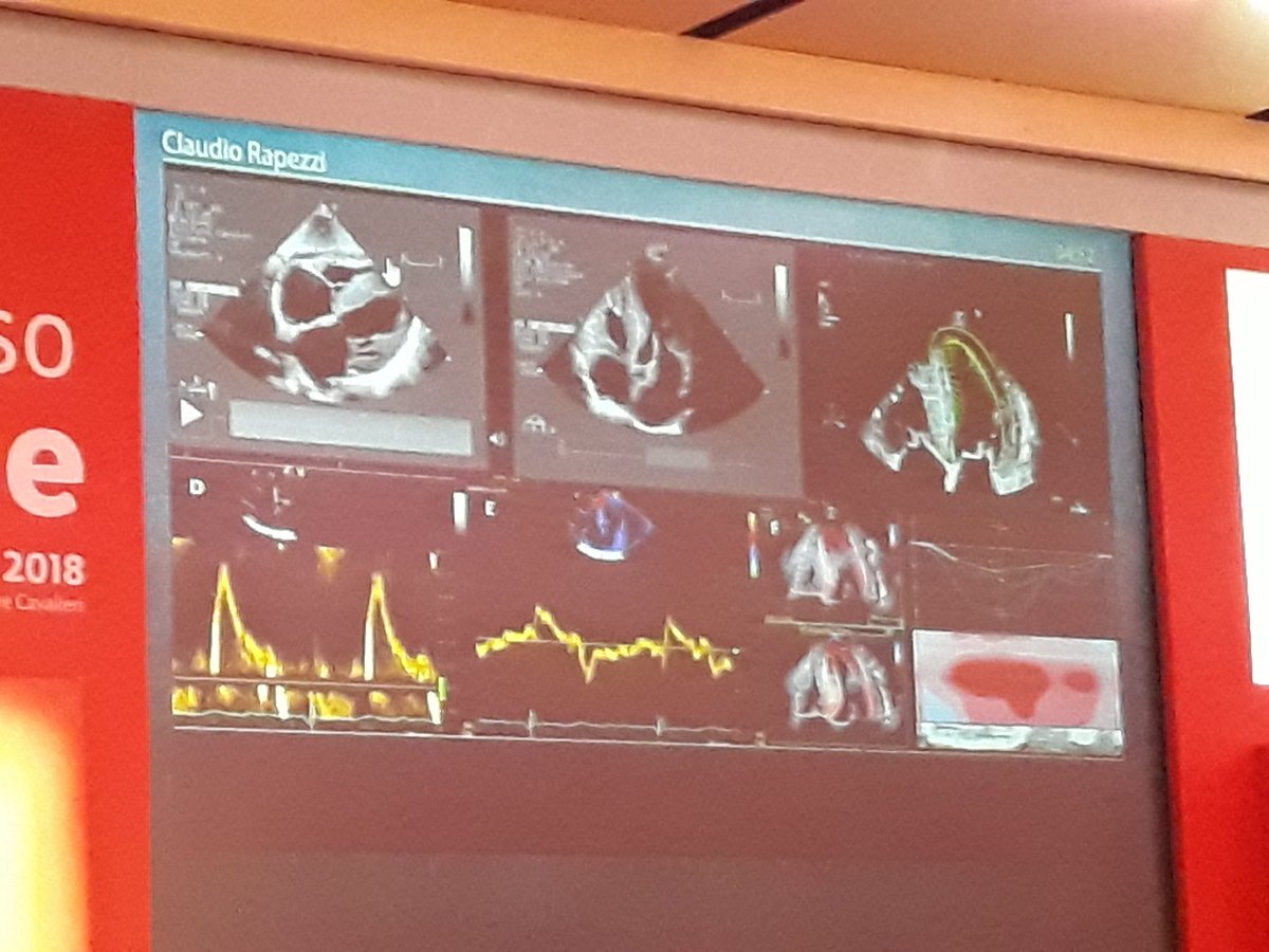 SilCastelletti's tweet photo. Prof Rapezzi: Key echo features of the #amyloidosis - check always the longitudinal function & look for the apical sparing pattern! #cardiomyopathy #Genetics #SIC2018 #ItalianSocietyOfCardiology
#SICCongress @glimongelli @Cipeciop1964 @CrottiLia @pelliccia_f @JGrapsa @JoelSMG https://t.co/mWP1dKEldZ