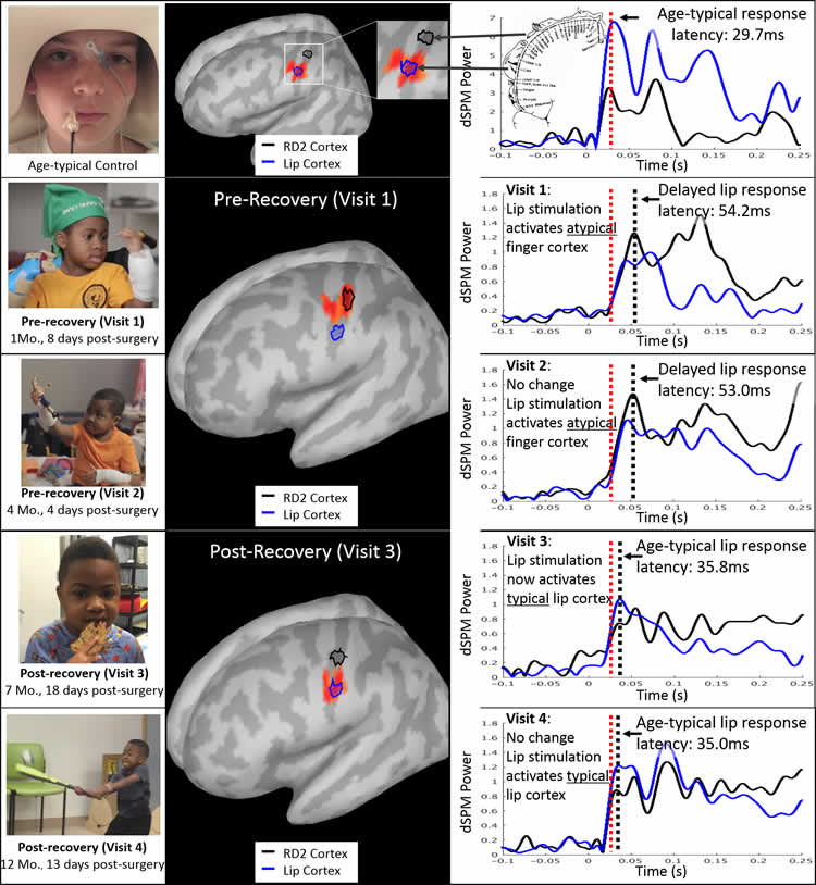 Brain mapping graphs