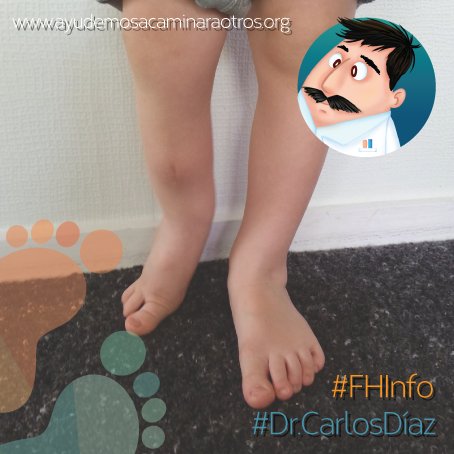 FHayudaacamina's tweet photo. #FHInfo se han reportado casos de Hemimelia Peronea en asociación con múltiples malformaciones #DrCarlosDíaz https://t.co/RrSekIhybN