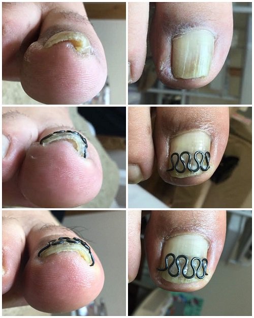 巻き爪矯正センター 快梛 Al Twitter 痛みが出始めたのは１年前だったそうです 痛む側を斜めに深く切っていたそうです 片側の爪の端が釣り針のように巻き込んでいました １段目 初回矯正前 ２段目 初回矯正後 ３段目 ２回目 43日後 矯正後 巻き爪 巻き爪