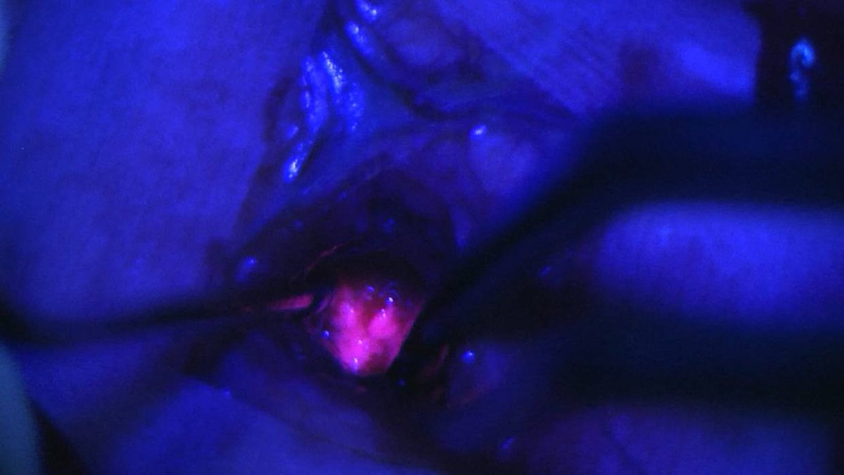 #Researchers: #Glowing #Cancer Cells Easier to Find, Remove.
oncology.euroscicon.com
Dye used in one of the experiments is called ICG. when large amounts of the dye were put into the blood before surgery it would collect in cancer cells, exposed to infrared light, they glow.