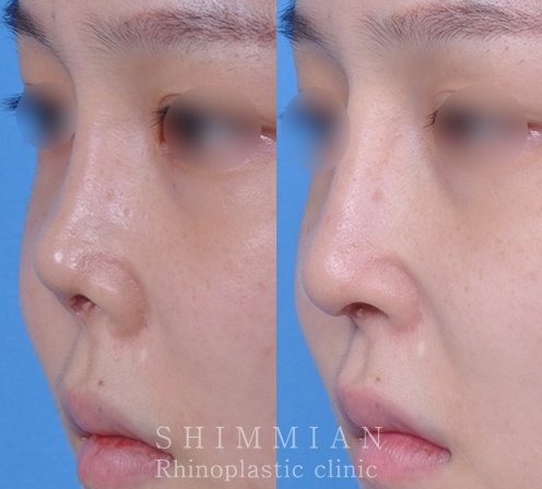 手術症例】 拘縮になった鼻の矯正例です。 鼻の穴と鼻先が正面からよく