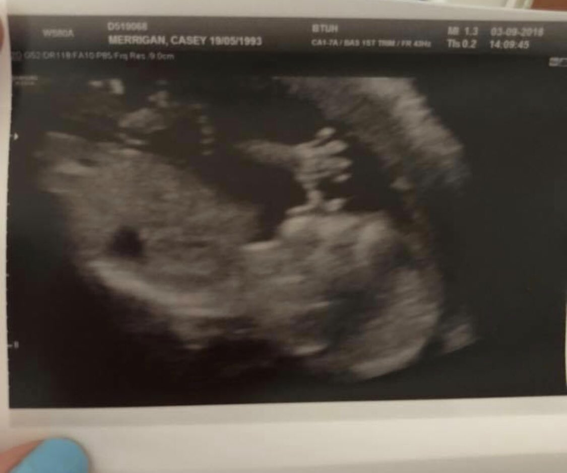 MsCaseyx's tweet image. Best scan picture ever ! This was at 12 weeks and i am 28 weeks this Thursday, time is going quick 👶🏻 we nearly all prepared for you baby boy #BabyBoy #Pregnant #UltraScan 👶🏻