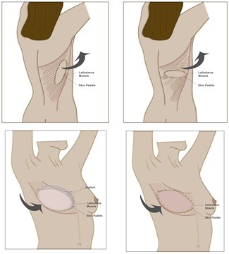 Tissue flap #surgery after #mastectomy is a way to rebuild the shape of #breast.
Know more regarding #breastaugmentation after #breastcancer from the #experts .
Log onto -goo.gl/k4dGLp
#FelizMartes #Breastisbest #BreastCancerAwareness #ManikarnikaTrailer