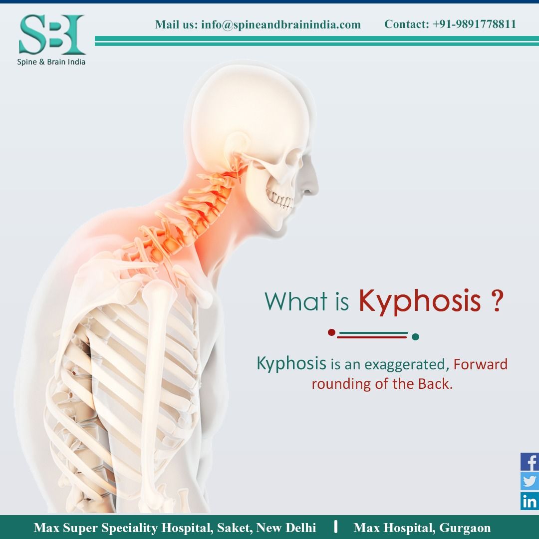 spinebrainindia's tweet image. #Kyphosis is a #SpinalDisorder in which an excessive outward curve of the #Spine results in an abnormal rounding of the upper back. The condition is sometimes known as &quot;roundback&quot; or—in the case of a severe curve—as &quot;hunchback.&quot;