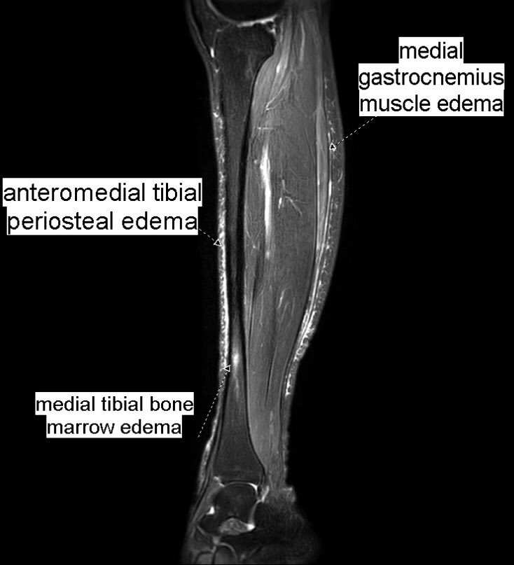 Benoît Rizk on Twitter "Same 27 y.o. runner presented yesterday with