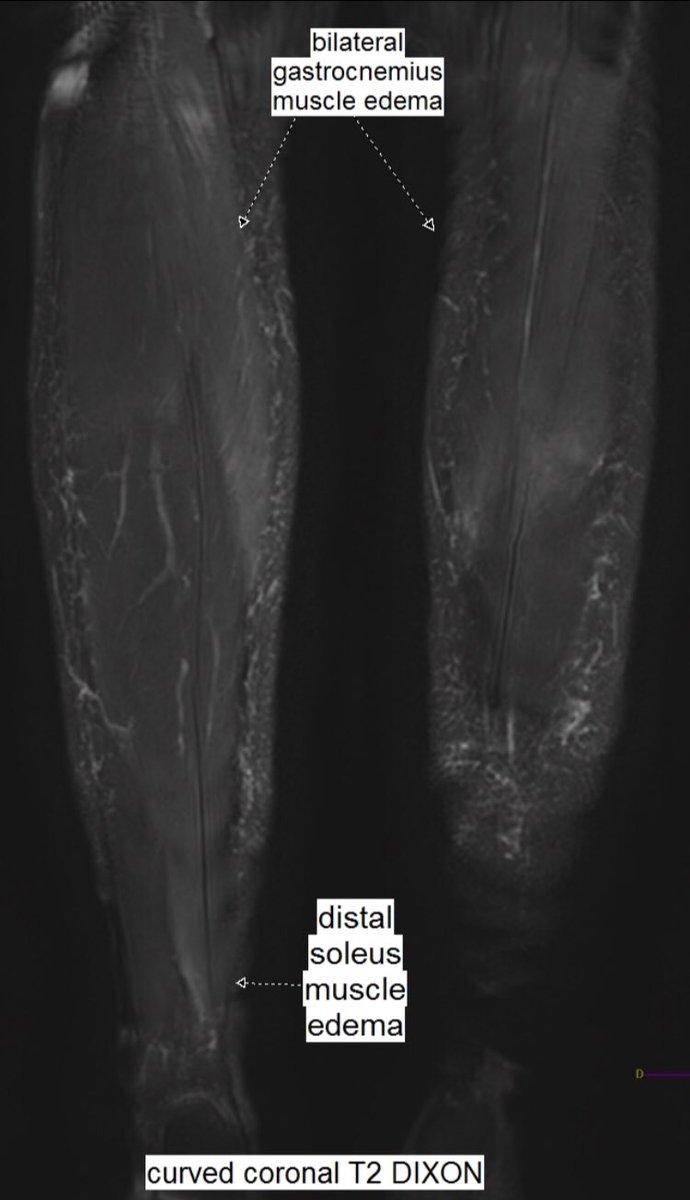 Benoît Rizk on Twitter "Same 27 y.o. runner presented yesterday with