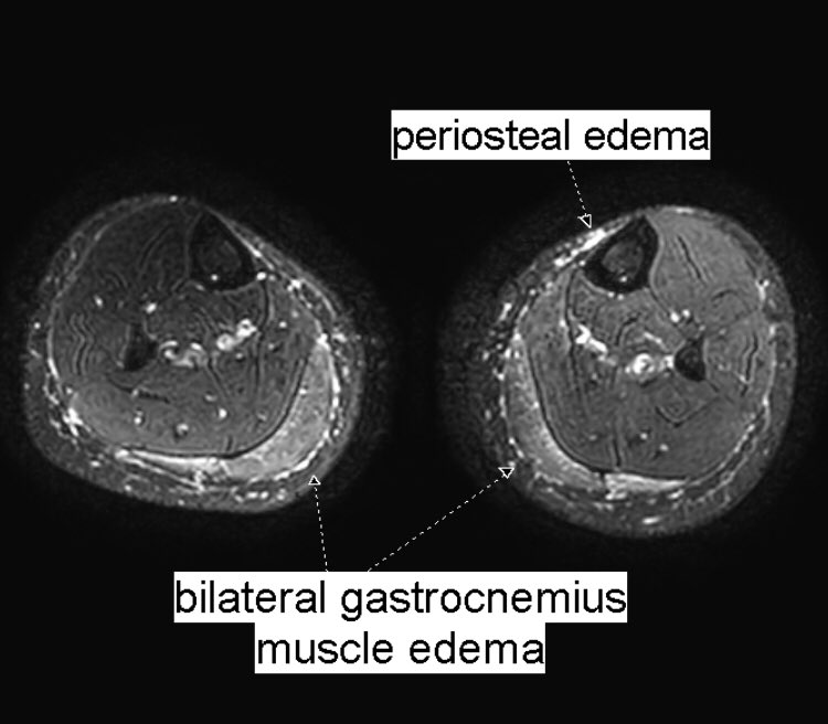 Benoît Rizk on Twitter "Same 27 y.o. runner presented yesterday with