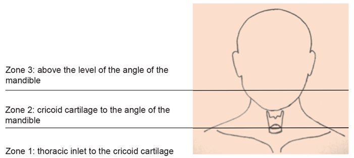ENT_AudsNews's tweet image. “Significant morbidity and mortality may result from major blunt neck injury due to the risk of laryngotracheal disruption.”

Kate Stephenson discusses #PaediatricENT trauma 
entandaudiologynews.com/features/ent-f… 
#ENTAuds