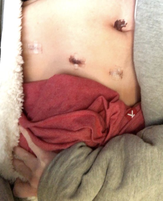Minus one #gallbladder!  The surgery was successful.  Now I just need to recover.  #laparoscopy #gallbladderremoval<a href="/tag/gallbladder"class="tags">#gallbladder</a><a href="/tag/model"class="tags"><span>#model</span></a><a href="/tag/surgery"class="tags"><span>#surgery</span></a><a href="/tag/recovery"class="tags"><span>#recovery</span></a><a href="/tag/pornhub"class="tags"><span>#pornhub</span></a><a href="/tag/laparoscopy"class="tags"><span>#laparoscopy</span></a>