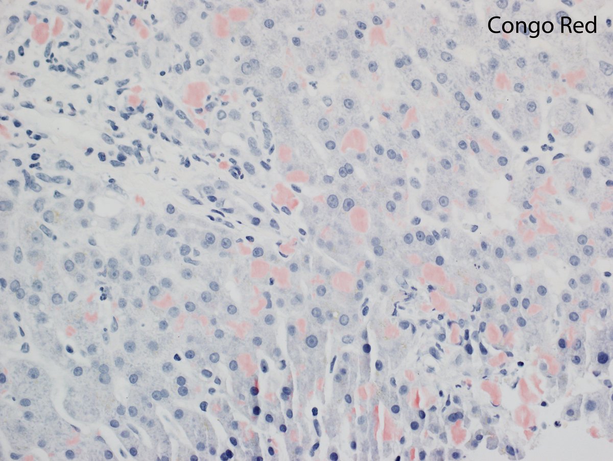 neuthunter's tweet photo. A more subtle case of hepatic amyloid. In the liver, this globular pattern of amyloid is highly specific for ALECT2, an unusual type of amyloid associated with patients of Hispanic ethnicity. The globules are seen in the sinusoids, portal tracts, and around central zones. https://t.co/aRMvQfotew