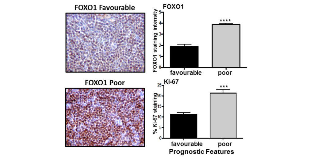 New research article: AKT/mTORC2 inhibition activates FOXO1 function in CLL cells reducing B cell receptor-mediated survival. sm.aacr.org/W06k30n1U3n