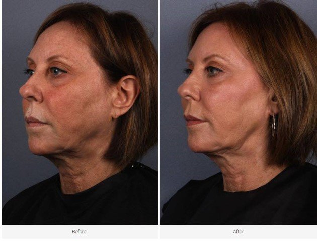 DallasSkin's tweet image. Lost volume and vitality? The #Restylane family of fillers are designed to help fill the cheeks, lips and even restore youthfulness to your hands! Results are visible within hours and last for 12-18 months.
