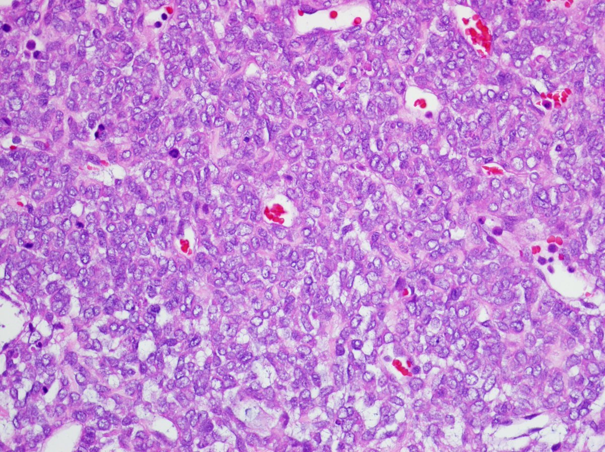 Another classic #pedipath renal tumor.

Clear cell sarcoma of kidney
1) Unlike #Wilms... Very firm, not friable and has mucoid cysts
2) All blastema + delicate capillary vessels
3) CyclinD1 +
4) Either YWHAE translocation OR BCOR ITD mutaion (mutually exclusive)

#pathology