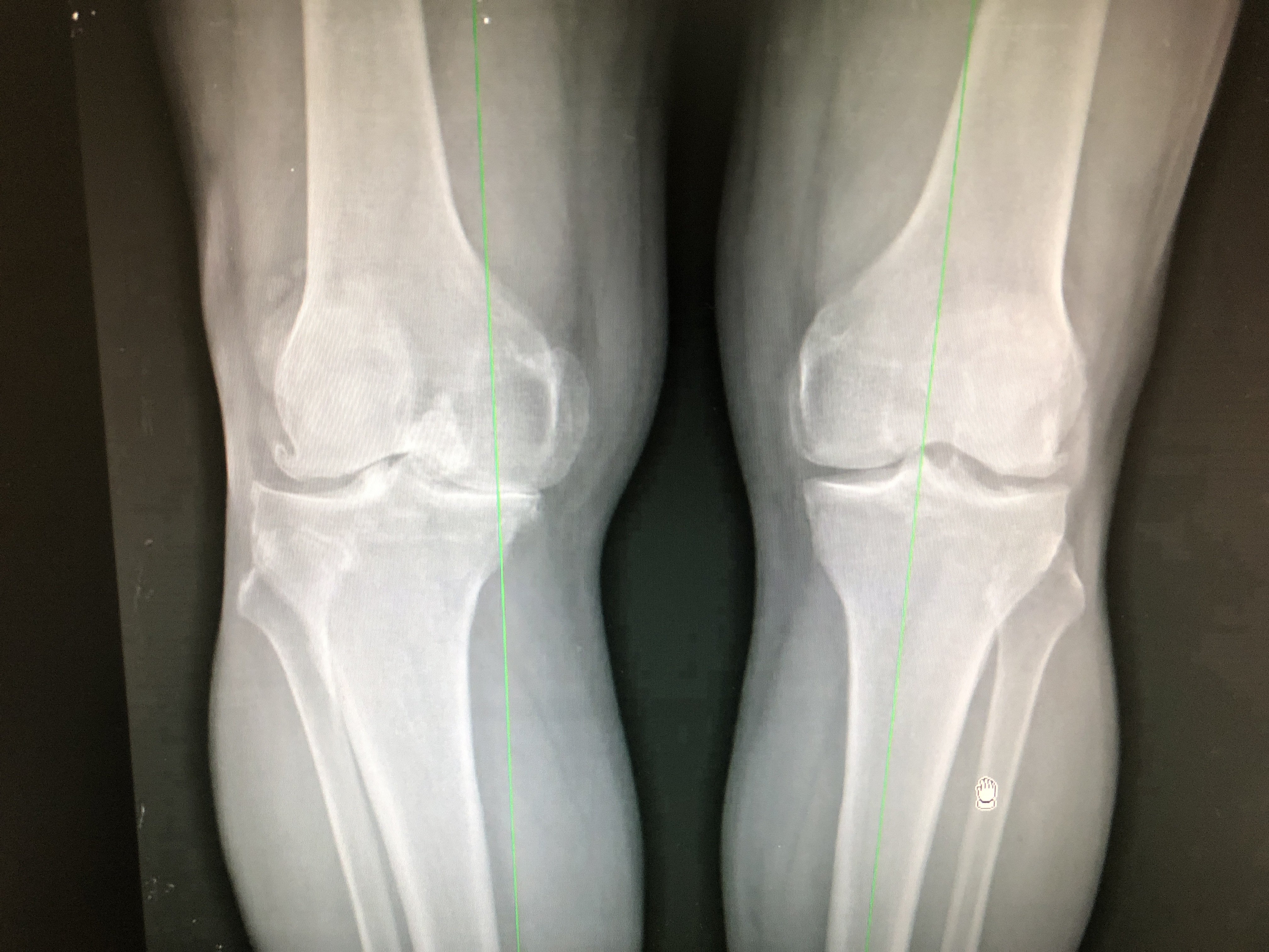 Lesiones de rodilla: hipótesis inicial basada en la anamnesis