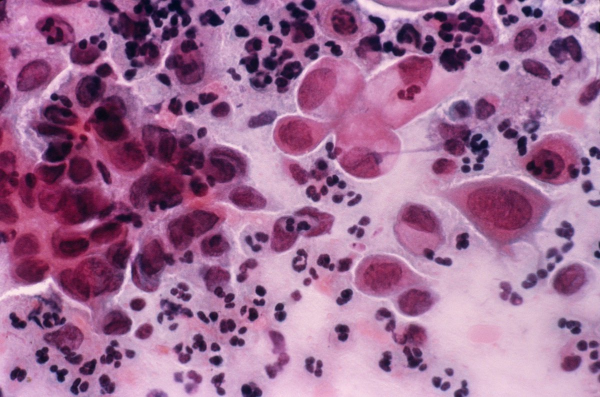 Global Gathering @ International platform for Cancer 
info @ oncology.euroscicon.com
#HPV #Discovery raises hope for new #CervicalCancer #Treatments.
#Causes_of_cancer #CancerMetastasis #OrganSpecificCancer 
#CancerScreening #CancerDiagnosis #CancerDrugs #CancerVaccines