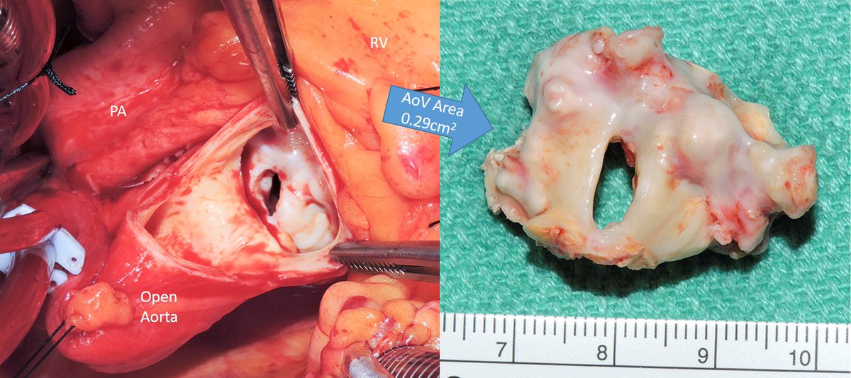 Can’t TAVR this! Worst aortic valve stenosis in 61y F, valve area 0.29cm2, peak / mean grad 171/110 mmHg, EF 38% - Tx: MiniSAVR Cardiac surgery picture of the week #CardSurgPOW