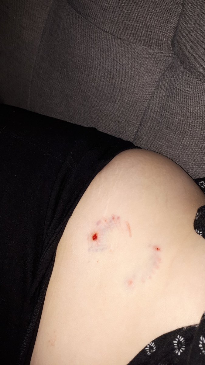 4reins's tweet photo. Got bit by my 70pounds dog last night. It was an accident and all the fault is on me because I got between my 2 dogs fighting for food...I'm okay, it doesn't hurt to much but please peeps dont do what I did haha.
#wildlife #dogsfight #IMOKAY https://t.co/HVsBNzNaXZ