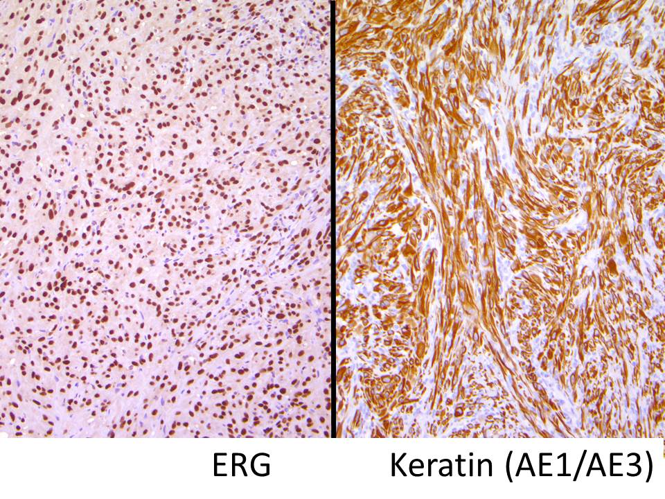 B_C_Dickson's tweet photo. PSEUDOMYOGENIC HAEMANGIOENDOTHELIOMA. NGS: ACTB-FOSB. NB: plump epithelioid cells with occasional cytoplasmic inclusions; ovoid nuclei with small nucleoli; focal stippled calcification; this genetic variant more often unifocal than SERPINE1-FOSB (PMID: 30256258, 30459475). https://t.co/5iYODCPMul