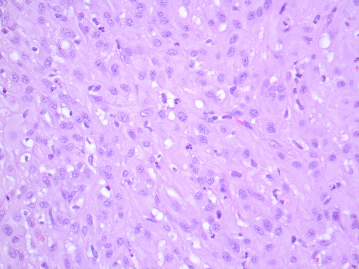 B_C_Dickson's tweet photo. PSEUDOMYOGENIC HAEMANGIOENDOTHELIOMA. NGS: ACTB-FOSB. NB: plump epithelioid cells with occasional cytoplasmic inclusions; ovoid nuclei with small nucleoli; focal stippled calcification; this genetic variant more often unifocal than SERPINE1-FOSB (PMID: 30256258, 30459475). https://t.co/5iYODCPMul