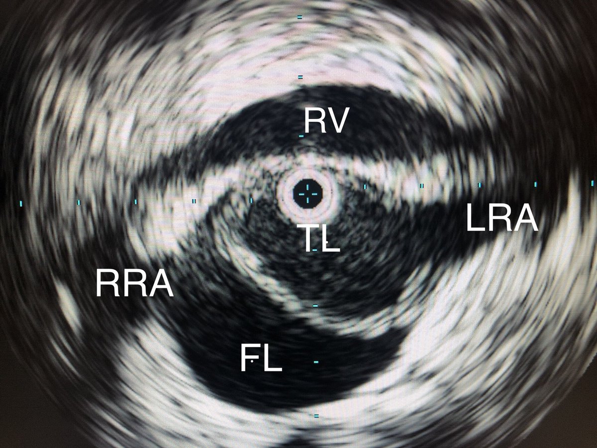 DrAliAzizzadeh's tweet photo. Type B #aortic #dissection #renal #artery #malperfusion treated with #IVUS #angioplasty #stent #Vascularsurgery @CedarsSinai https://t.co/sxI9Dus06f