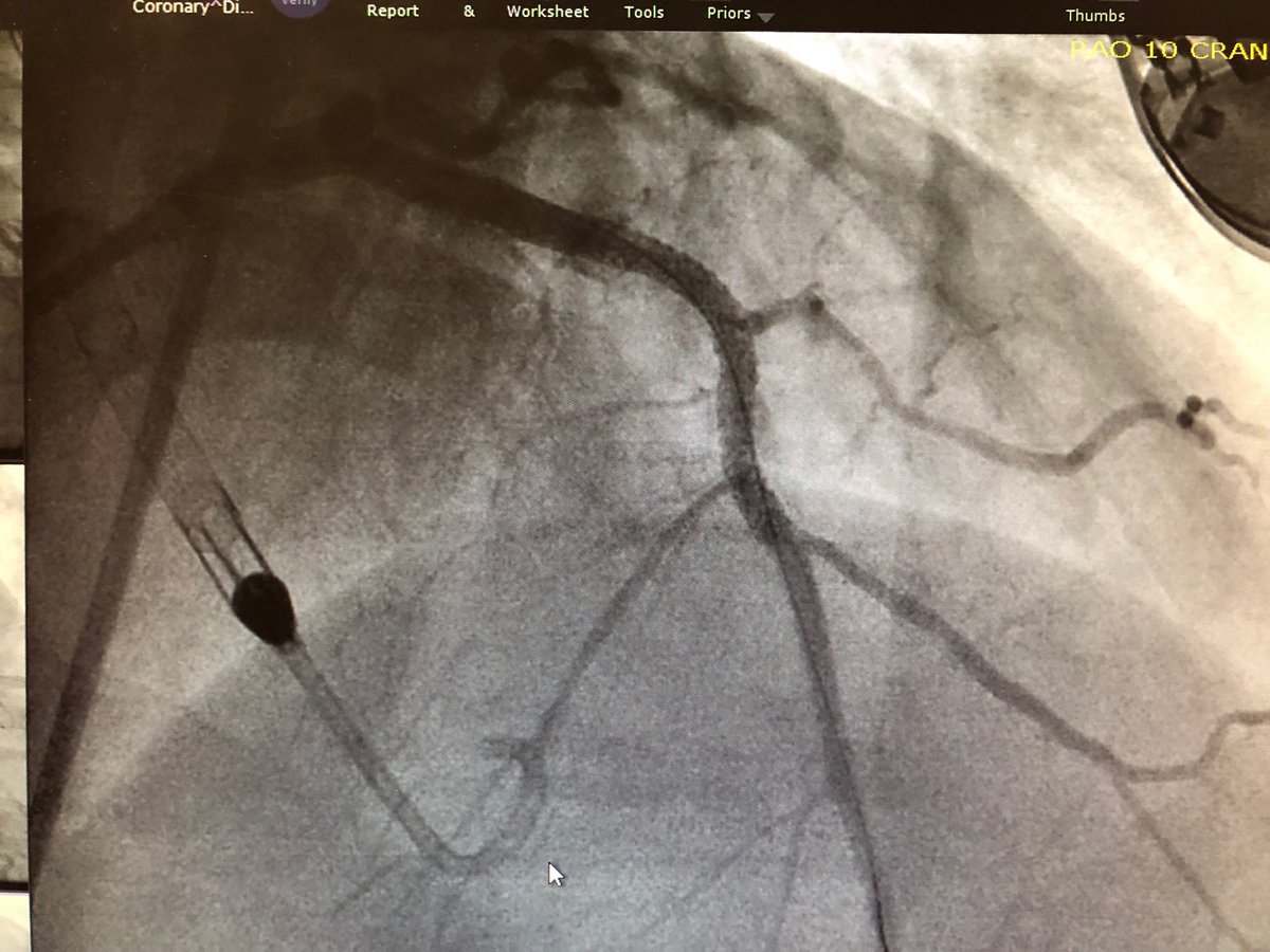 First #percax approach for #CHIP #PCI at #BSWhealth Temple.  Stable hemodynamics allowed adequate #roto PCI.  Thanks ⁦<a href="/rcstoler/">Robert Stoler MD</a>⁩ &amp; ⁦<a href="/DrAmirKaki/">Amir Kaki, MD</a>⁩ for coaching, ⁦and <a href="/DrArgyle/">R. Jay Widmer</a>⁩ for the assist.  ⁦<a href="/HeartOTXHeartMD/">John P Erwin III MD MBA MACC (#BigPoppy )</a>⁩