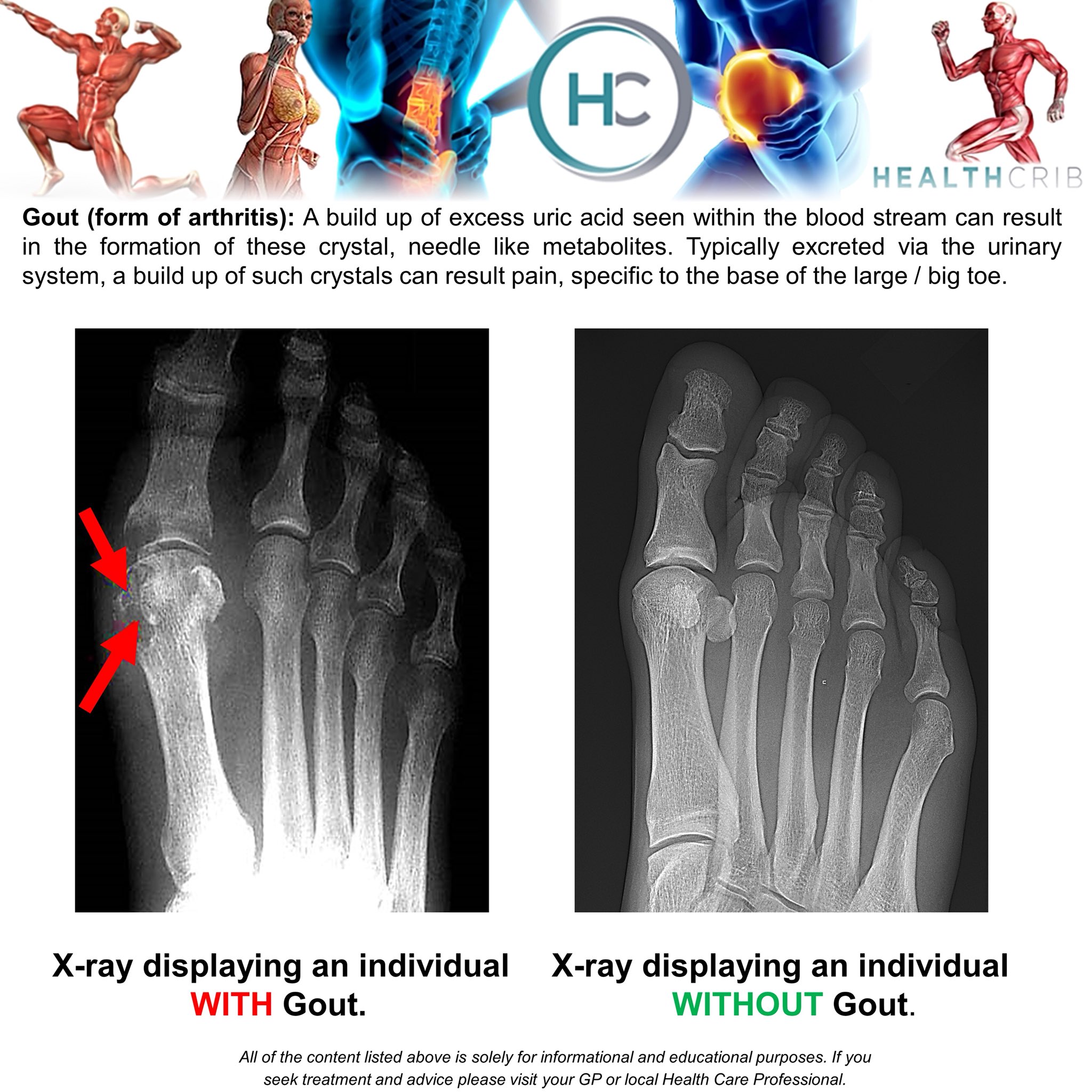 Gout Xray