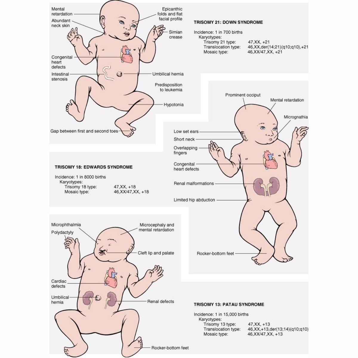 Aapa Students على تويتر Common Trisomies Trisomy 21 Down Syndrome Heart Defects Predisposition To Leukemia Simian Crease Trisomy 18 Edwards Syndrome Heart Defects Renal Malformations Small Mouth Large Occiput Trisomy 13 Patau