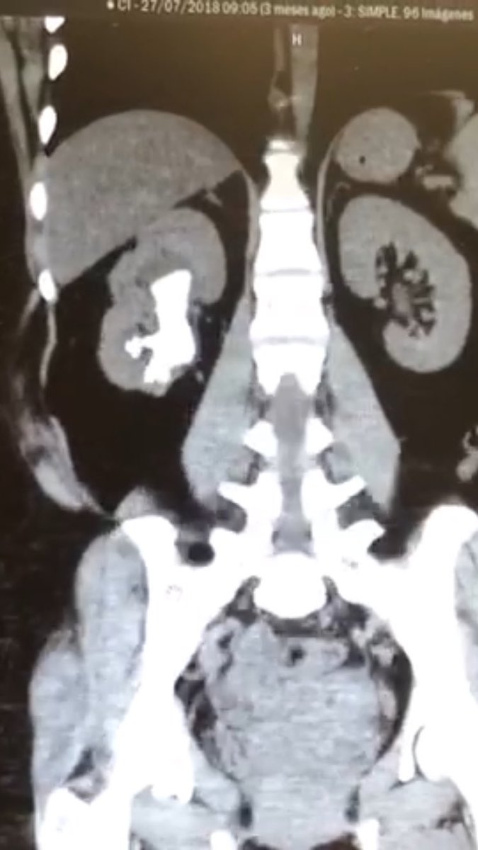 uronavarrete's tweet photo. female with previous open surgery 3 ys ago 24fr supine NLPC for new right staghorn stone, stone clearance, no way of comparison, nice pic but I can’t believe someone still doing this  #endouro https://t.co/am7rapEyHh