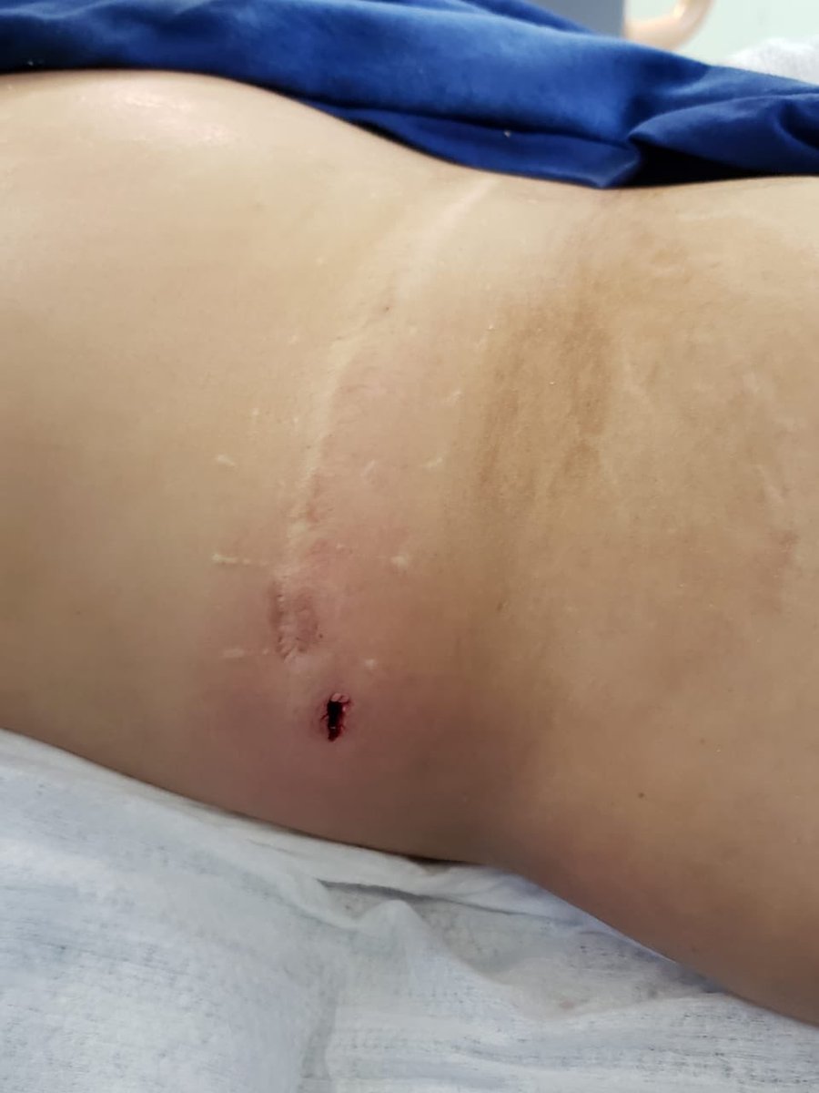 uronavarrete's tweet photo. female with previous open surgery 3 ys ago 24fr supine NLPC for new right staghorn stone, stone clearance, no way of comparison, nice pic but I can’t believe someone still doing this  #endouro https://t.co/am7rapEyHh