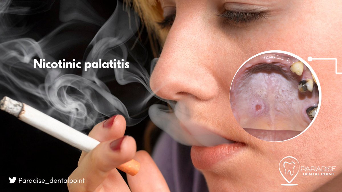 PDentalpoint's tweet photo. Take care about this disease! #ParadiseDentalPoint #Palatitis #FamilyOfDentist #Cancun 😯
-
Contact us and our team at Paradise Dental Point will be happy to help you:
☎️+52 1 (998) 121 3510 https://t.co/G9Ui6LnnFX
