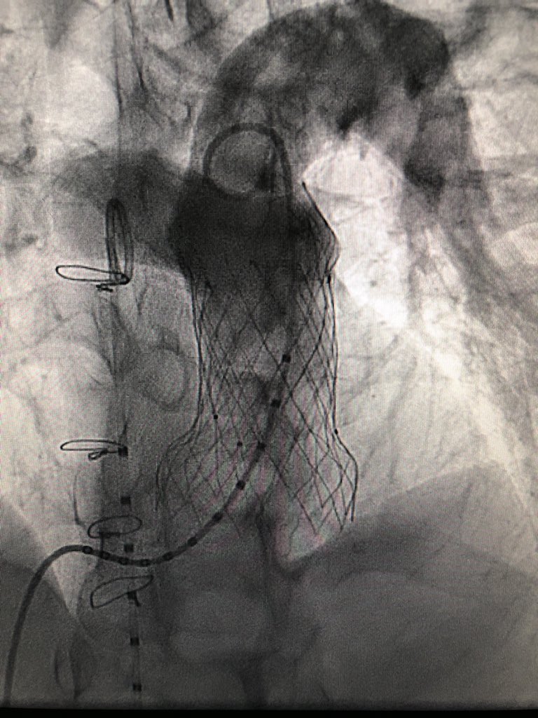 Complex percutaneous #StructuralHeartDisease Day (Mitraclip, ViV Mitral and TPVR)