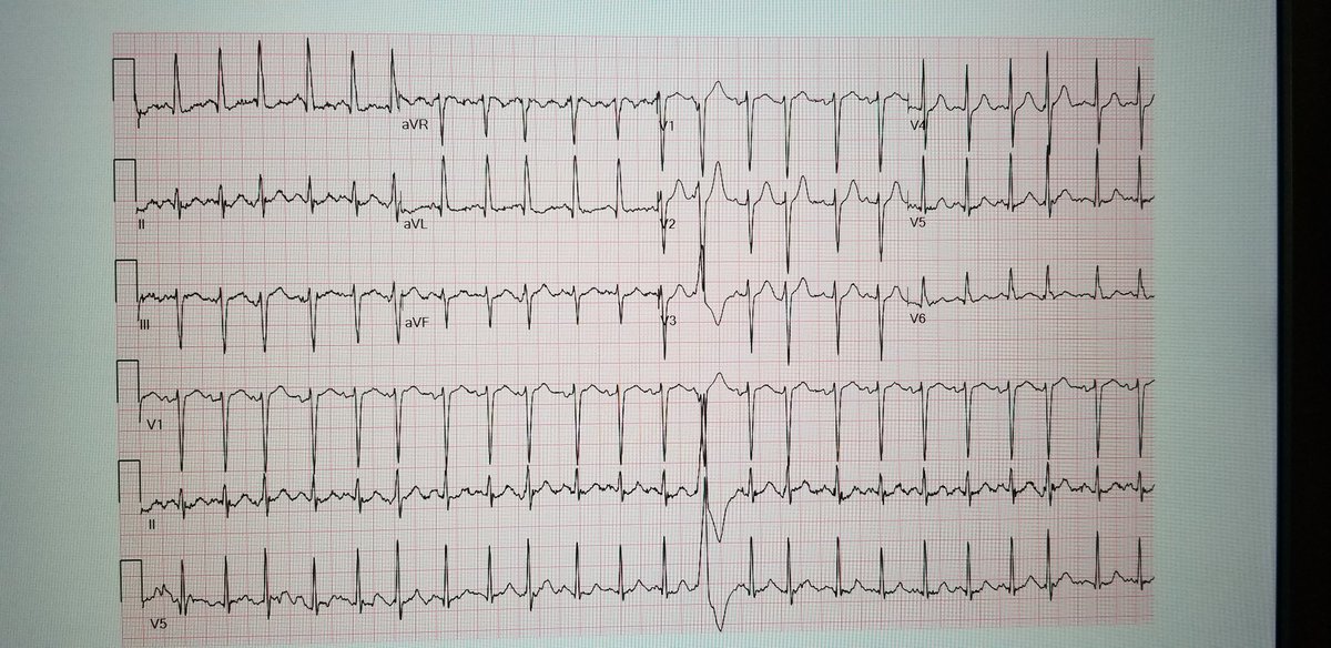bawejamd's tweet photo. 55 yo diabetic with CP + dyspnea. EKG in ED called out as STEMI. Note unusual P axis. Valsalva performed. P axis changes as SVT converts to sinus. Repeat EKG: sinus tach & the STs appear fine. How many times has ER called stemi on SVT?
#ekgfirst #accfit @ShariqShamimMD @momermd https://t.co/fGN9KdFHRB