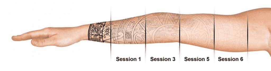 AestheticBC's tweet photo. There are several ways that we can #Remove unwanted #Tattoos, but the most popular is #LaserAssisted. Depending on the #Colour and type of the #Ink, @DrAshishDutta can #Eliminate these using a variety of #Lasers and #WaveLengths.
https://t.co/yt10ODo4RU https://t.co/1z8HQiktRQ