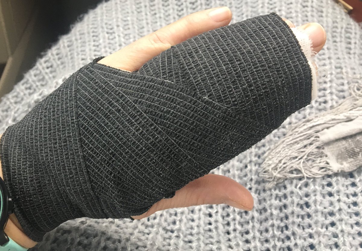 skyhighshoes's tweet photo. No running for me at the mo... a sweaty hand does not make for good burns recovery! But at least it’s giving me time to think about what I really want to do with my running this year 🤔 Hopefully not too long before I’m back out there!! 
#2019runninggoals @UKRunChat https://t.co/qtX14UCXyb