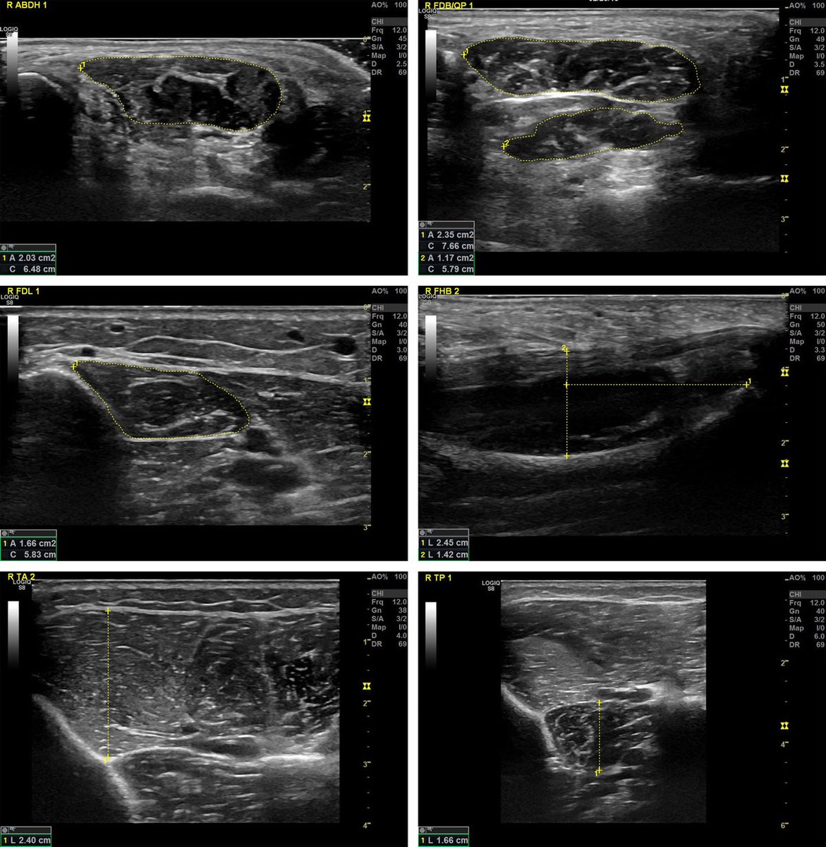 MSSEonline's tweet image. Minimalist shoe walking is as effective as foot strengthening exercises in increasing foot muscle size and strength. The convenience of changing footwear rather than performing specific exercises may result in greater compliance. ow.ly/Uopv30n7Pfh #minimalistshoes