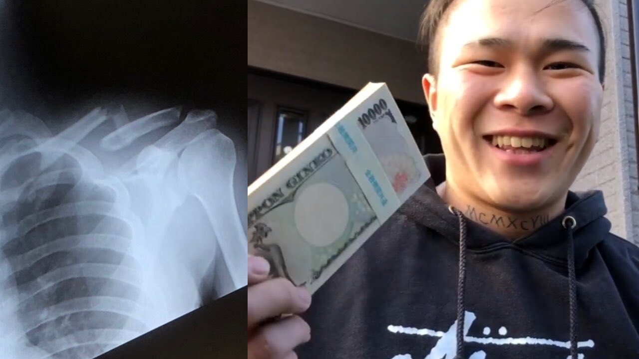 がーどまん 今日のサブチャンネル モナリザ複雑骨折動画にでない理由 手術 です是非みて下さい動画 動画のurlは下に貼ってます T Co Piqxnfiufj T Co Xodgnir8tu Twitter