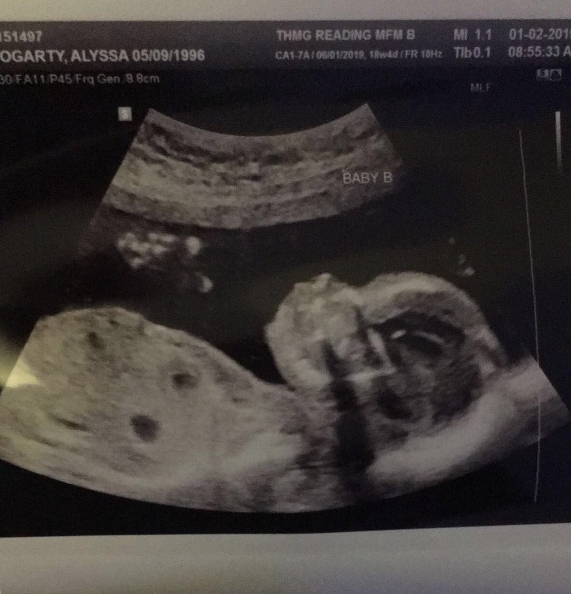 alissy0808's tweet photo. The boys are healthy and happy! Weighing 10 and 11 oz! Nelson was nothing but smiles the whole appointment 🥰 https://t.co/J1Pwrbhrsg