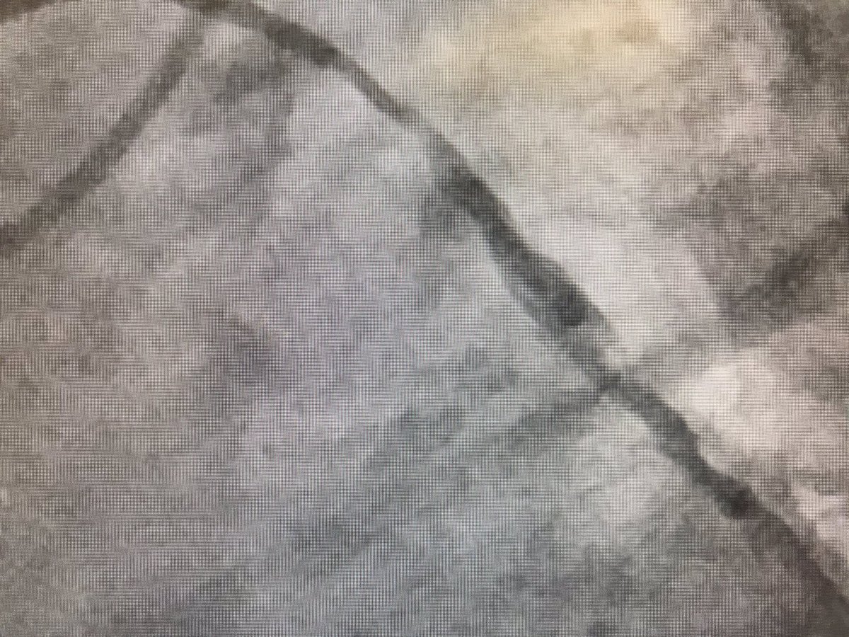 Quick case thread + lesson for fellows. PCI for thrombotic vein graft. Acute presentation no filter landing zone no easy native fix 1/5 #FITT
<a href="/SVRaoMD/">Sunil V. Rao</a> <a href="/DocSavageTJU/">Michael Savage</a> <a href="/CardiacConsult/">Jordan Safirstein MD</a> <a href="/KaulP/">Prashant Kaul</a> <a href="/yadersandoval/">Yader Sandoval</a> <a href="/aelsab/">Abdallah El Sabbagh</a> <a href="/nolanjimradial/">Jim Nolan</a> <a href="/mmamas1973/">Mamas A. Mamas</a> @ajaykirtane <a href="/djc795/">David J. Cohen, MD, MSc</a> <a href="/DrArgyle/">R. Jay Widmer</a>