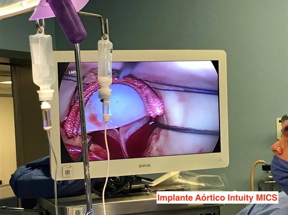 ICMImx's tweet photo. En ICMI felicitamos al Dr. Ledu Lara por el inicio del Programa de Procedimientos Cardiovasculares Mínimamente Invasivos "MICS", Implante de Válvula Mitral, Aortico y Cierre de CIA, Transcateter "TAVI" Evolut R y Sapiens 3 en el Hospital General Ignacio Zaragoza.
#ICMITeam https://t.co/Zv8eWcIUK8