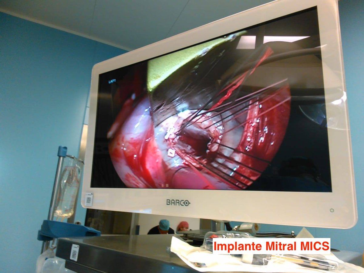 ICMImx's tweet photo. En ICMI felicitamos al Dr. Ledu Lara por el inicio del Programa de Procedimientos Cardiovasculares Mínimamente Invasivos "MICS", Implante de Válvula Mitral, Aortico y Cierre de CIA, Transcateter "TAVI" Evolut R y Sapiens 3 en el Hospital General Ignacio Zaragoza.
#ICMITeam https://t.co/Zv8eWcIUK8