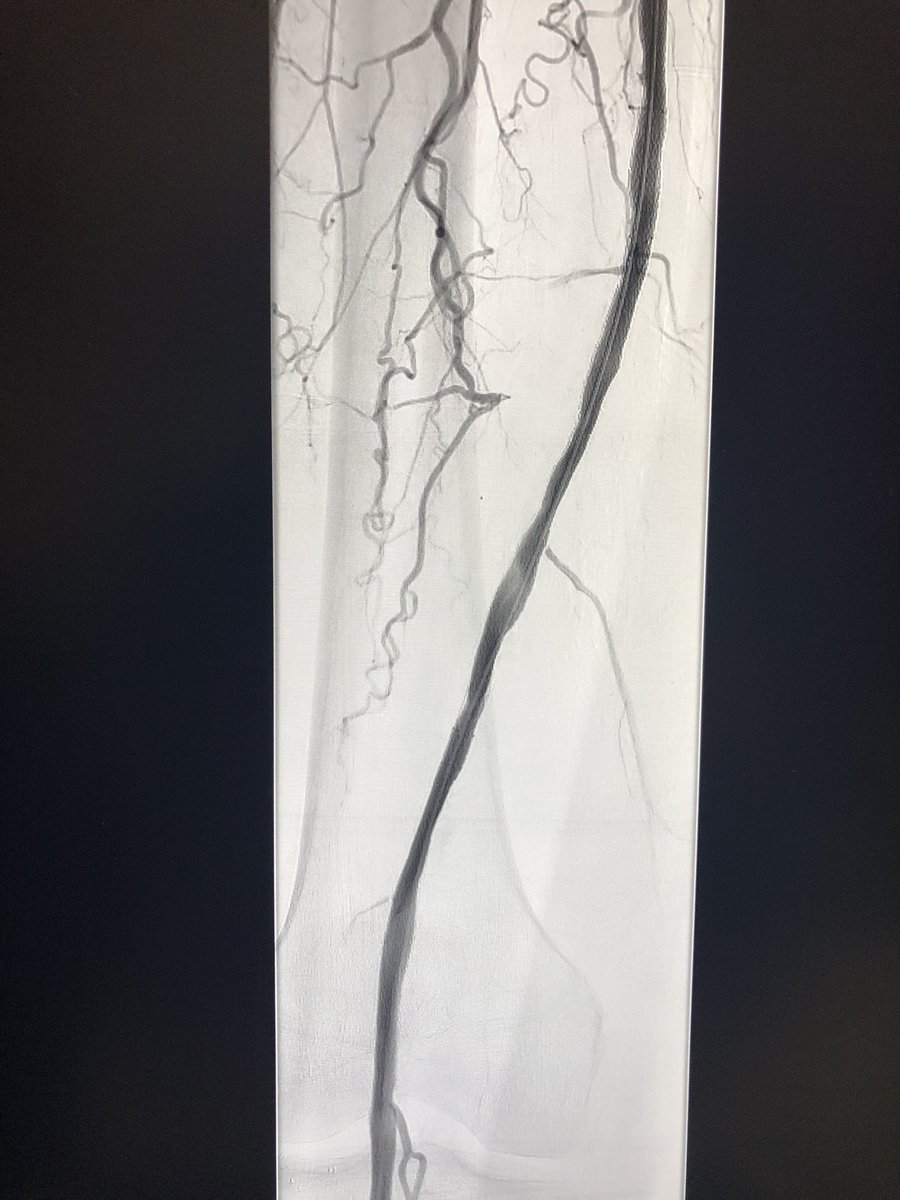 roblookstein's tweet photo. Live @MountSinaiIR Rutherford 3 Claudicant #CTO tx with #Eluvia for #palpablepulse #Eluviafirst @SIRspecialists @SIRRFS @bsc_pi https://t.co/WfRYIQhqD7