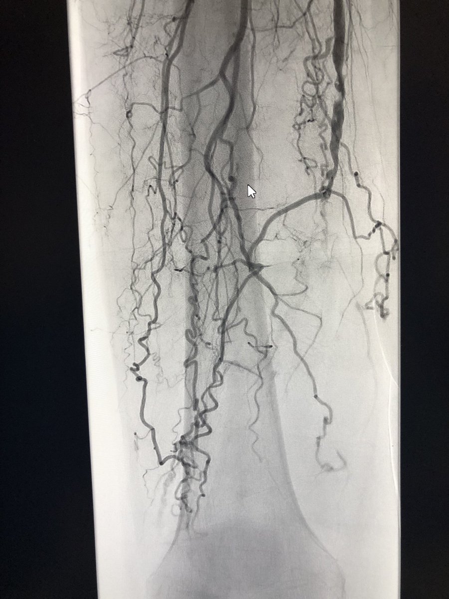 roblookstein's tweet photo. Live @MountSinaiIR Rutherford 3 Claudicant #CTO tx with #Eluvia for #palpablepulse #Eluviafirst @SIRspecialists @SIRRFS @bsc_pi https://t.co/WfRYIQhqD7
