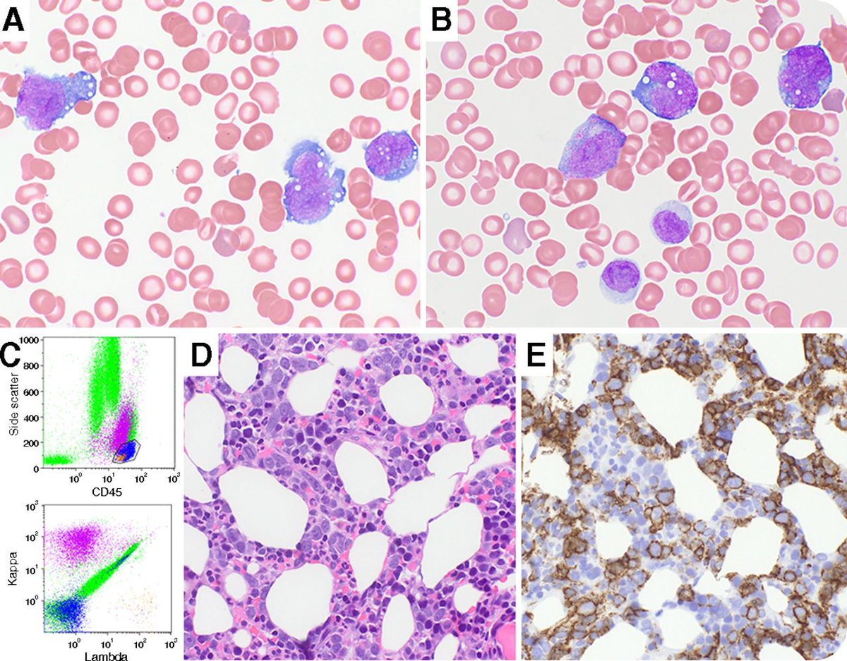 DİFFÜZ BÜYÜK B HÜCRELİ LENFOMA 
#DBBHL #Diffüzbüyükbhücrelilenfoma #hematolojiistanbul #immünoterapi #kanser #kemoterapi #kökhücrenakli #lenfkanseri #lenfoma #memorialataşehirhematoloji #profdrhisari #RCHOP #radyoterapi profdrhisari.com/diffuz-buyuk-b…