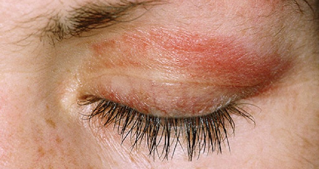 MD on Twitter "Dermatomyositis makes your muscles and joints ache