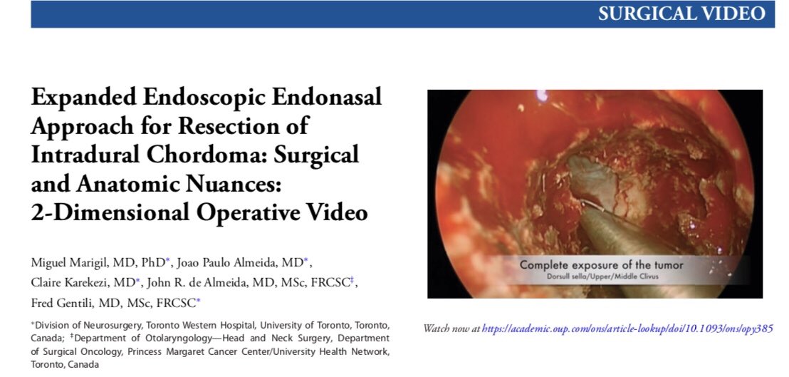 clairekarekezi's tweet image. Relevant Anatomy and Surgical Nuances in the resection of Intradural Skull Base Chordoma via the Expanded Endoscopic Endonasal Approach | Operative #Neurosurgery  | #SkullBaseSurgery | #EEEA. Our Latest Surgical Video: 👇🏾academic.oup.com/ons/article-lo…