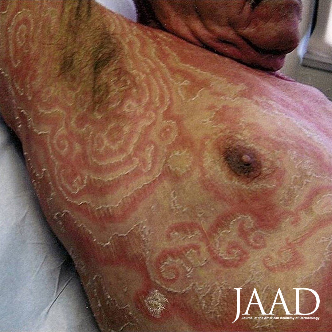 JAAD Journals on X: "Erythema gyratum repens https://t.co/YnzhcW2Fm7  https://t.co/r93bNDLVT0" / X
