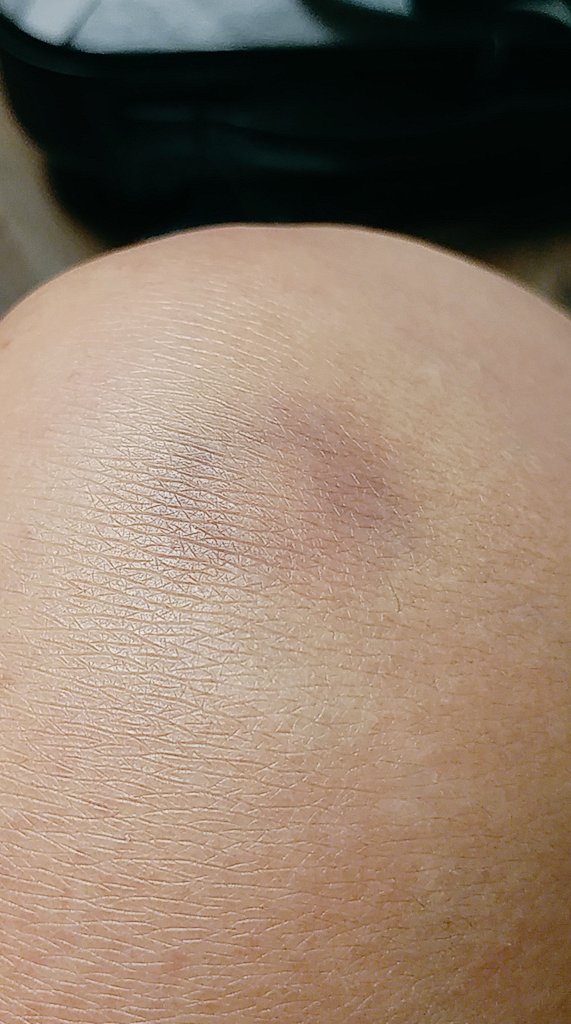ashna_s's tweet photo. Also in other news, a mysterious bruise has now appeared on my knee just in time for my travel. #PictureForReference Hahaha. Yes! I actually did take a photo of my knee for reference. No! This is not the weirdest thing I did today. And, Yes! I do question my sanity sometimes. 😅 https://t.co/FIg9nPt8xJ