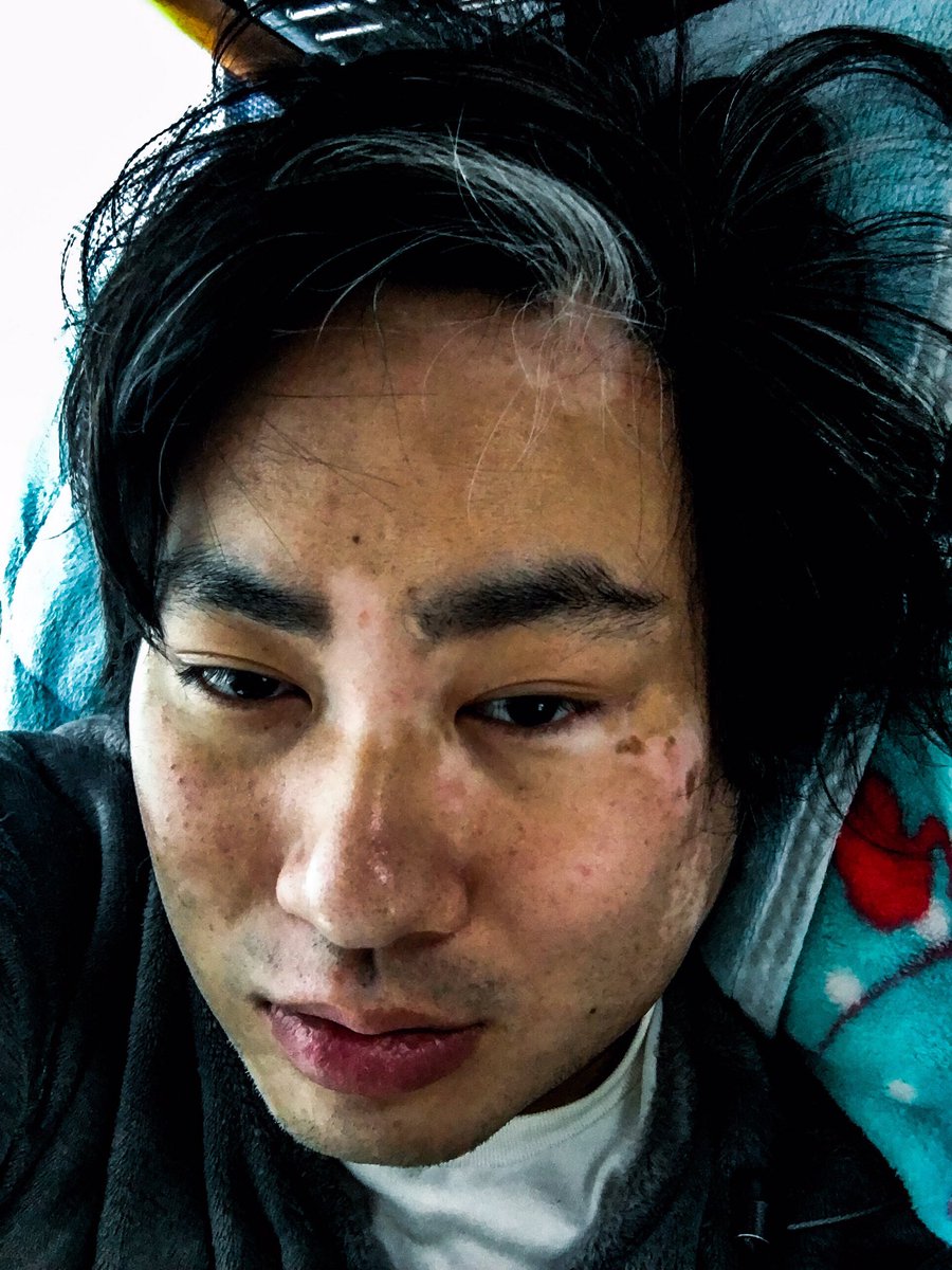 オルマン در توییتر 尋常性白斑という免疫疾患なんだけど肌が模様のように白くなっちゃうんだ 加工してわかりやすくしたからグロいけど あぁこれが白斑かってわかると思う 隠す方法はあっても治す方法は無い 俺自身は気にしてないwww 尋常性白斑